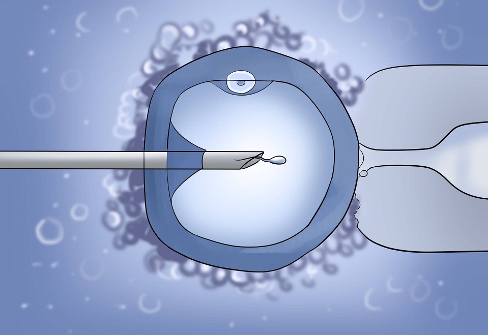 Intracytoplasmic Sperm Injection (ICSI)