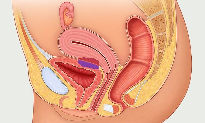 Endometriosis